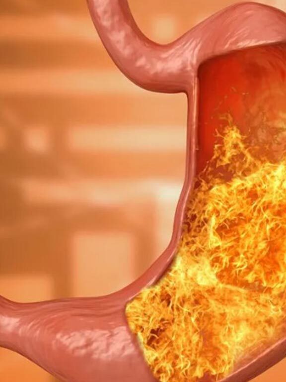 mide asidi yetersizliği